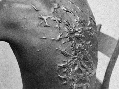 McPherson & Oliver, Peter Gordon, The Scourged Back (Le dos flagellé), 1863. Public domain